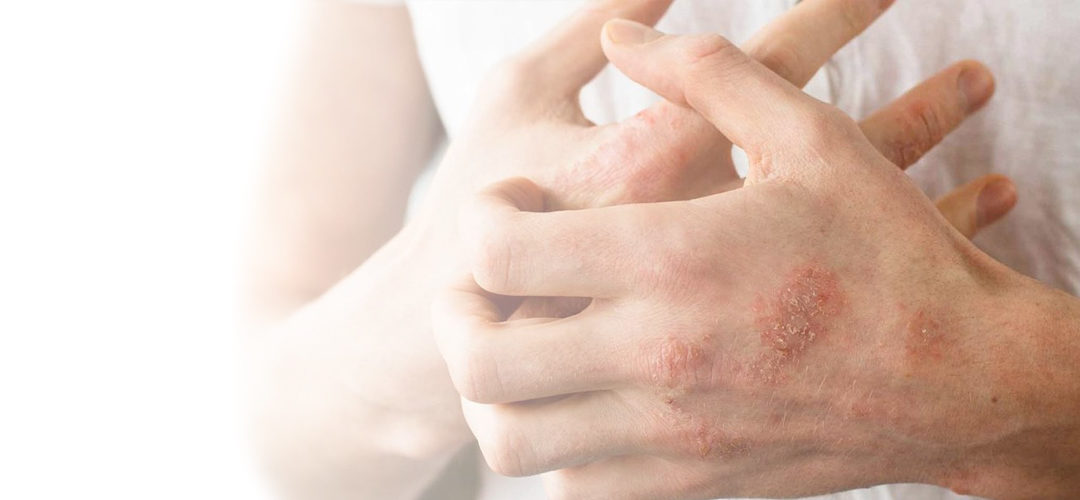 Fighting eczema? Here are 4 products that help